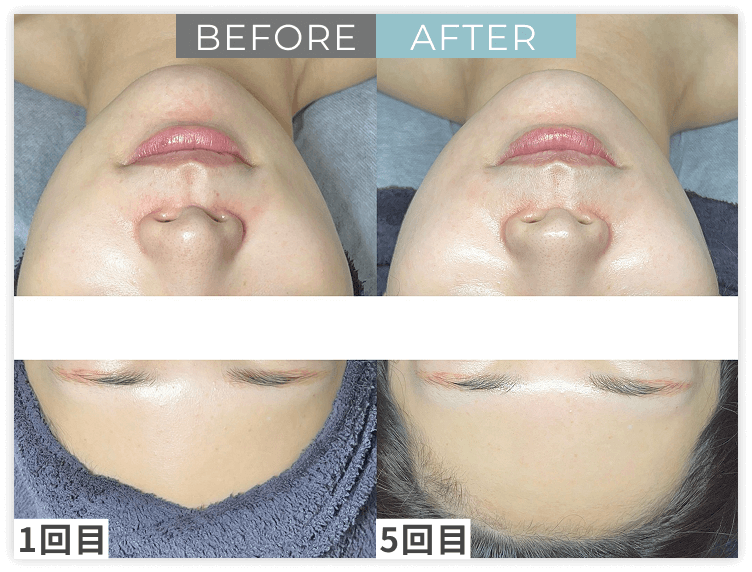 ララピール×LDMのビフォー/アフター