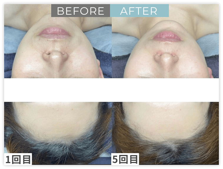 ララピール×LDMのビフォー/アフター